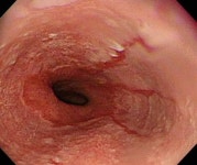 역류성 식도염 원인은? 가볍게 여기고 방치하면 식도암으로 발전할 수 있어...