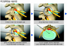 [Health&Beauty]광혜병원 “척추관 협착증 치료, 추간공 염증 깨끗이 없애는 게 관건”