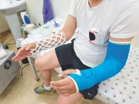 한국 기술로 개발 ‘오픈 캐스트’… 건강보험 적용 기대