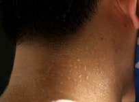 땀 악취증 환자, ‘30대 이하’ 74% 압도적…예방법은?