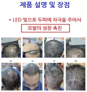 “‘탈모 치료’ 온라인 허위 광고 의약품, 성기능 장애 우려”