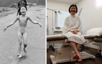 베트남전 ‘네이팜탄 소녀’ 50년만에 화상치료 마쳐