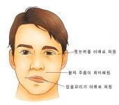 [전문의 칼럼]안면마비 증상 있다면 72시간 안에 치료받아야