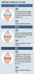 [병원 탐방] 무릎관절염 초기엔 약물로 관리… 더 진행되면 연골 수술 고려를