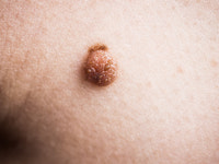 점인 줄 알았는데 피부암…어떻게 구별할까