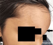 단순 코막힘인줄 알았는데…이마 부풀어올라 ‘깜짝’