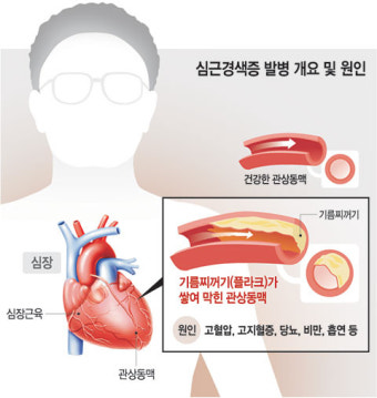 <김정일 사망 이후-急死 원인>뇌졸중→심근경색…예고된 사망, 당뇨·비만에 음주·흡연도 한몫