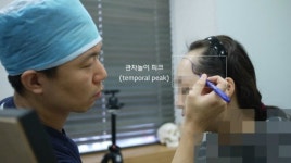 헤어라인 교정하면 어떤 모양이 될까?