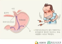 위식도 역류질환 증상 가슴이 쓰리거나 화끈거린다면?