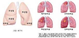 폐암 수술 부위 및 범위 따라  폐기능 보존 정도 다르다
