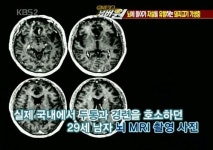 생고기 즐기던 여성, 뇌를 포함해 전신에 기생충 감염