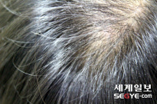[김기자와 만납시다] 젊은 내 머리의 스크래치…앗, 새치!