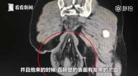 [세상에 중국] 게임 하느라 화장실서 30분여 앉았다가 직장탈출증으로 병원 신세
