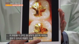 충치는 무조건 금니? 치과의사가 고백한 과잉진료