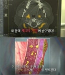 생로병사 이소성 지방은 무엇? 장기에 직접 쌓여 각종 성인병 위험 키워