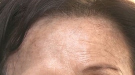 100% 천연 염료라더니…얼굴, 목 새카맣게 물든 헤나 염색 피해자들