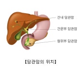 ‘침묵의 살인자’ 담관암 환자 희소식…항암제 치료반응 예측 가능해져