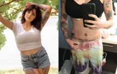 美서 가슴 축소 환자에 크기 키우고 지방흡입 수술