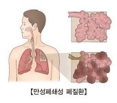 “만성폐쇄성폐질환 환자, 적정체중 이하로 줄지 않도록 해야”