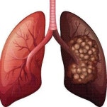 담배 한대 피운 적 없었는데 ‘폐암 4기’ 시한부 선고받은 女…무슨 일?