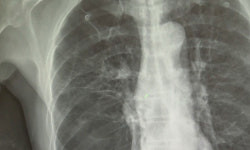 15년간 폐암 추적해보니… 발생률 상승↑, 5년 생존율 2배↑