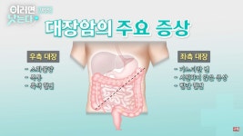 변비 오래가거나 이유 없이 체중 10% 빠지면 ‘대장암’ 의심해봐야