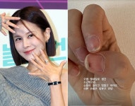 아이비가 공개한 멍투성이 손톱… 젤네일 때문에 걸렸다는 ‘이 질환’ 뭐길래