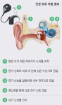 보청기도 소용없는 노인성 난청… 인공와우로 청력 회춘