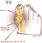 [HEALTH] 통풍 예방·치료엔 경혈 자극 침술이 효과