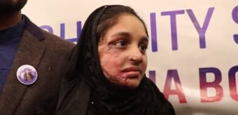 데이트 거절로 '염산 테러'…얼굴 녹은 소녀, 결국 법 바꿨다
