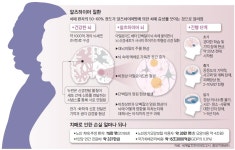[생각뉴스] 알츠하이머 정복, 첫걸음 내디뎠다