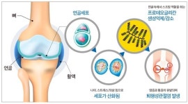 [건강한 우리집] 삶의 질 떨어트리는 관절염 통증, 연골세포 손상 때문