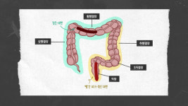 이건 보통 구린내가 아니다…화장실서 찾은 ‘대장암 신호’
