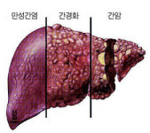 만성 B형 간염 초기 적극치료 해야 간암 예방