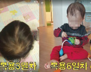  한약 먹은 아이 탈모 논란…한의원 부작용 ‘처방’ 없나 