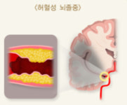 뇌졸중·뇌혈관질환 치료에 대한 건강보험 적용 범위 확대 