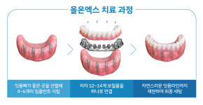 “올온엑스로 틀니 안녕”…고정성 치아로 되찾는 제2의 인생