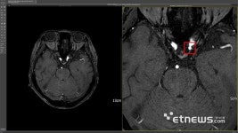 딥노이드 딥뉴로, 의료기관서 비급여 청구 시작