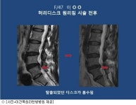 원리침, 중증 허리디스크 질환 약 60% 고쳐 ‘주목’