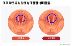 [주말엔 건강] 목소리 잘못 사용하면 성대에 혹·굳은살 생긴다