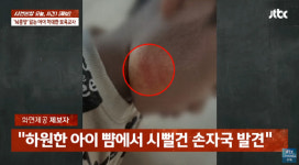 뇌종양 앓는 3살, 얼굴에 폭행 자국…어린이집 CCTV 보니 충격