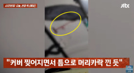 안마의자에 머리카락 뜯겨…사고로 다섯 바늘 꿰맨 여성[영상]