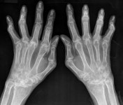 [건강]류머티스 관절염 여성환자 1년이내 관절변형 시작