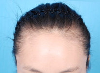 [맞춤 클리닉]毛 없는 아픔, 내 毛로 치유