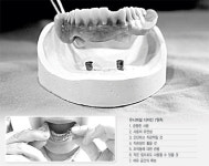 [건강]틀니도 이젠 ‘맞춤 디자인’ 시대