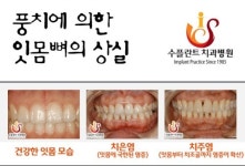 풍치, 조기치료 중요한 이유