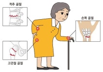 “백세시대 발목잡는 노년기 ‘골절’, 국가가 나서 관리할 때”