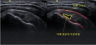 [김영범의 건강돌직구] 정상적인 퇴행변화로 발생하는 ‘회전근개파열’②