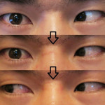 양안복시, 사시증상 치료는 정확한 진단이 먼저!