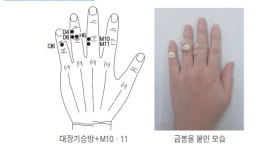 코로나19 일상에 지친 심신건강 돕는 수지침 치방